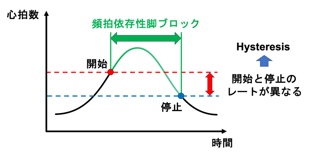 頻脈依存性脚ブロック(Tachycardia-dependent bundle branch block)