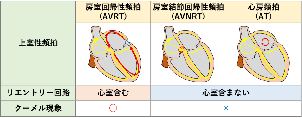 クーメル現象(coumel phenomenon)