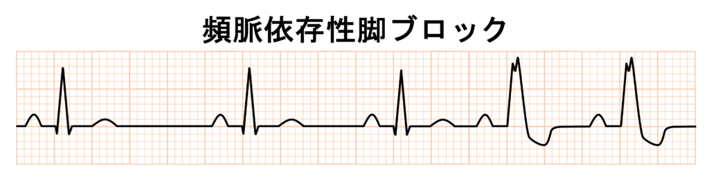 Linking現象(Linking Phenomenon)