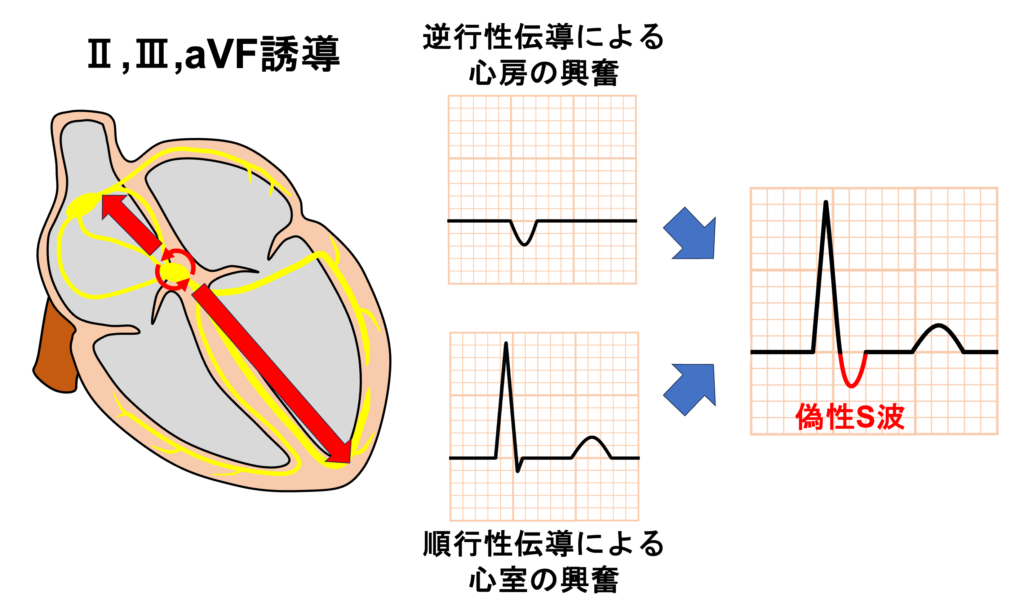 偽性S波(pseudo S wave)