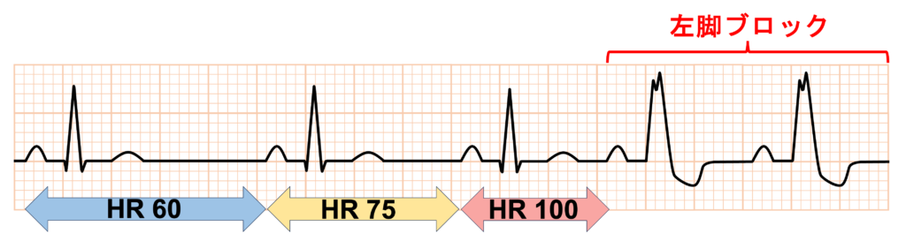 頻脈依存性脚ブロック(Tachycardia-dependent bundle branch block)