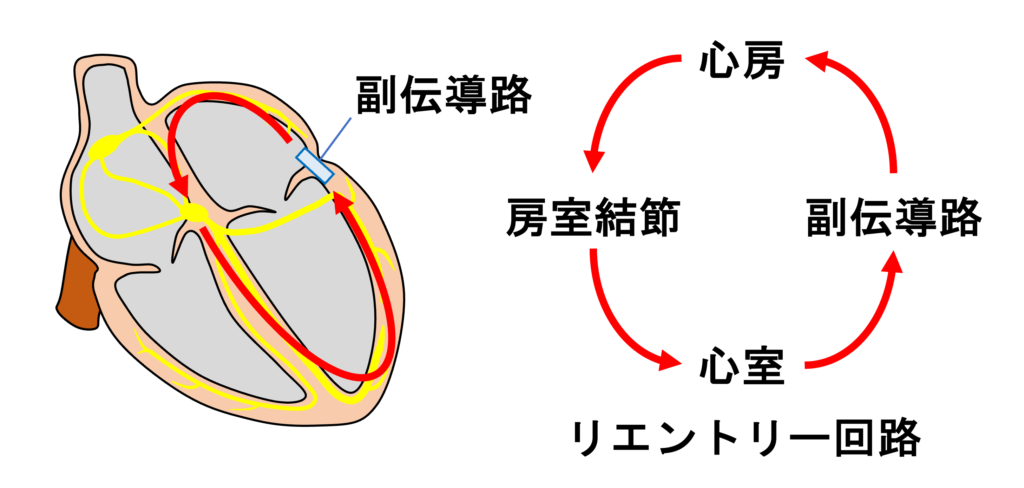 房室回帰性頻拍(atrioventricular reentrant tachycardia:AVRT)
