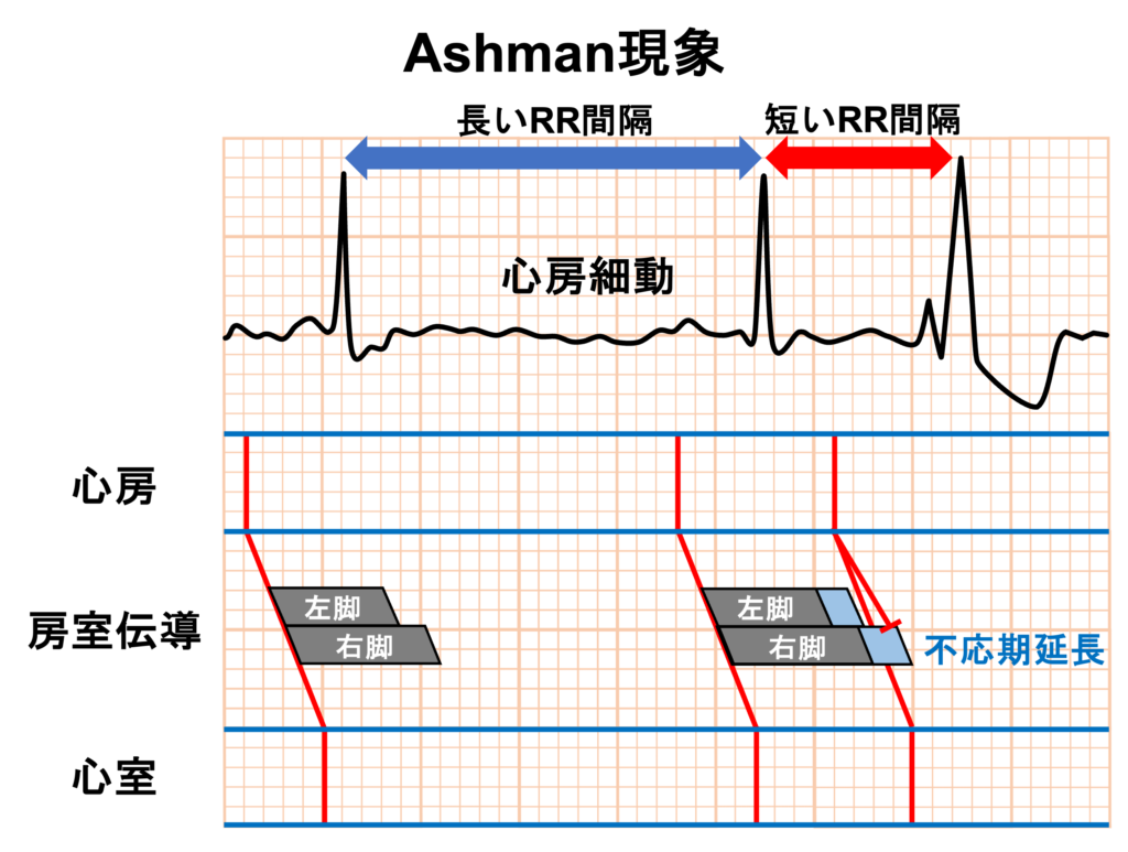 不応期(refractory period)
