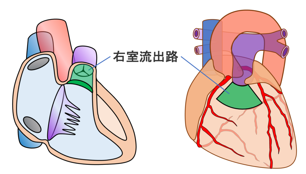 右室流出路(right ventricular outflow tract：RVOT)　