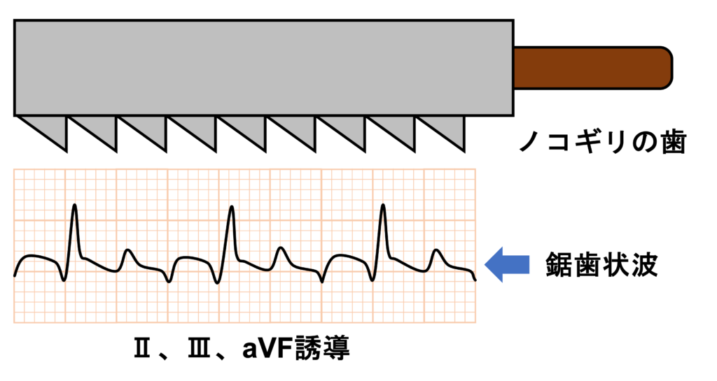 心房粗動(Atrial flutter)