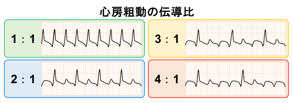 心房粗動(Atrial flutter)