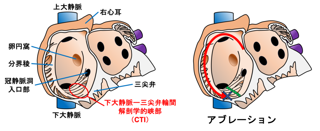 心房粗動(Atrial flutter)