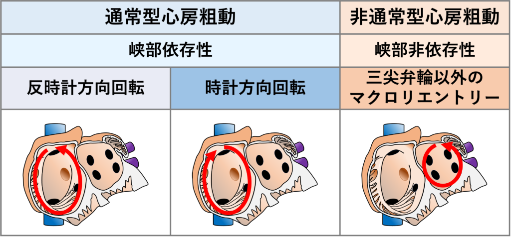 心房粗動(Atrial flutter)