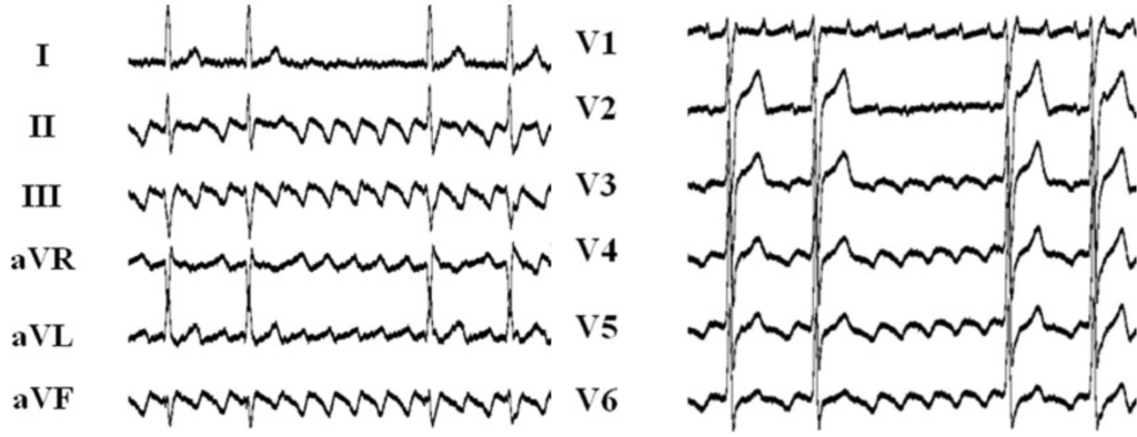心房粗動(Atrial flutter)