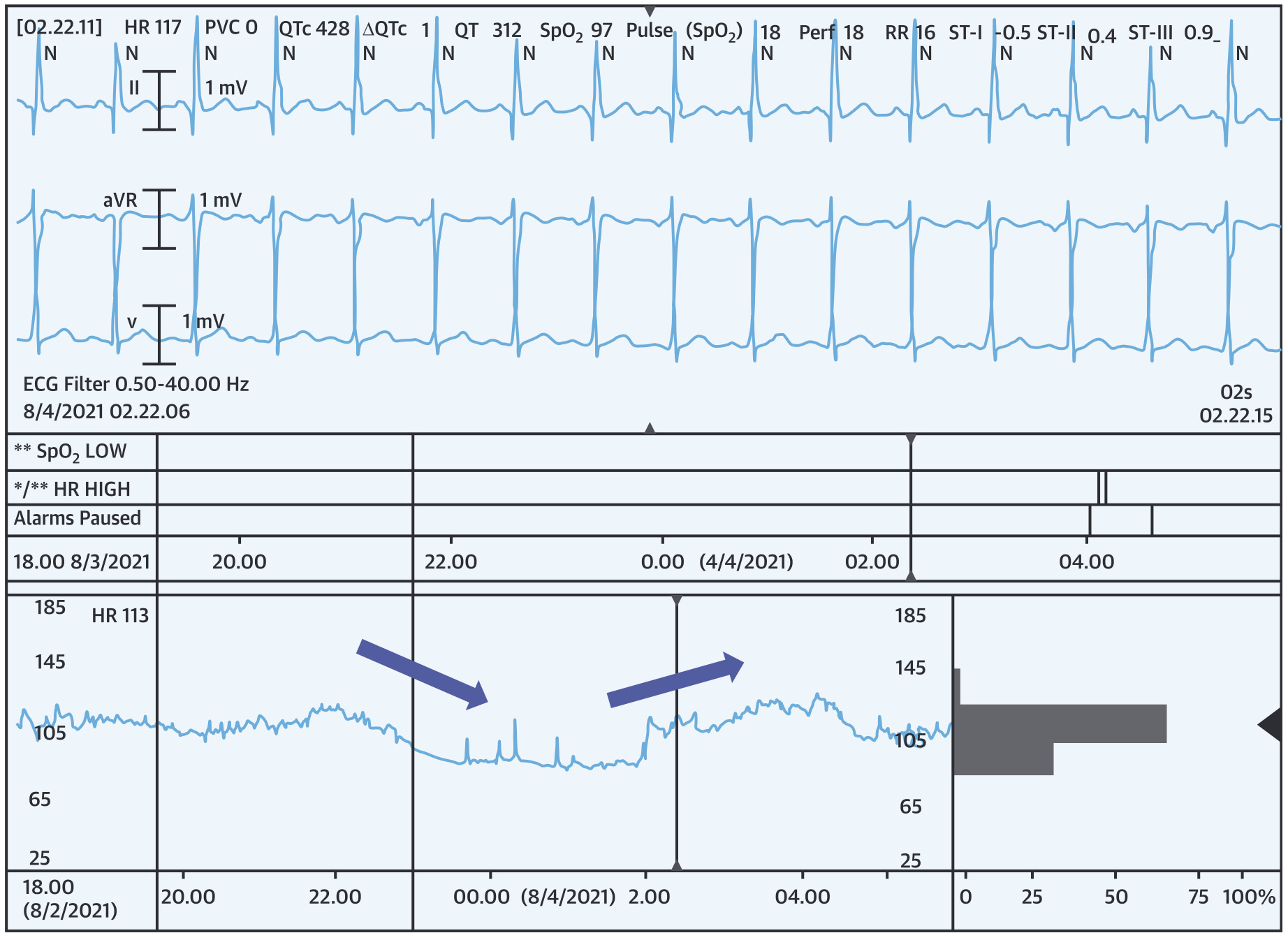 不適切洞頻脈(inappropriate sinus tachycardia)
