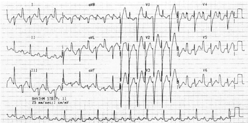 トリカブト中毒とは?