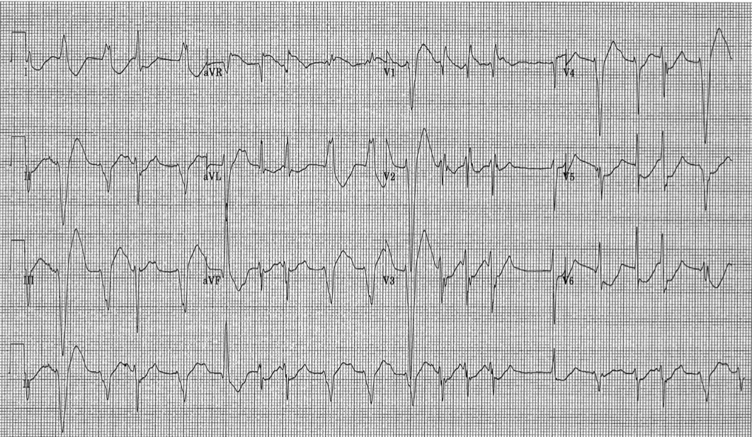 トリカブト中毒とは？