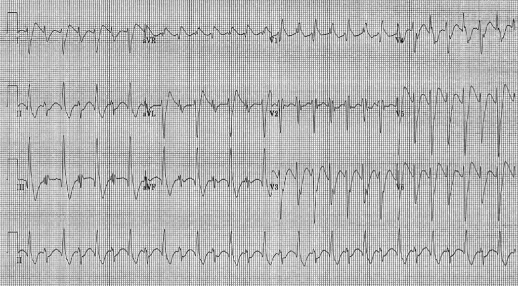 トリカブト中毒とは?