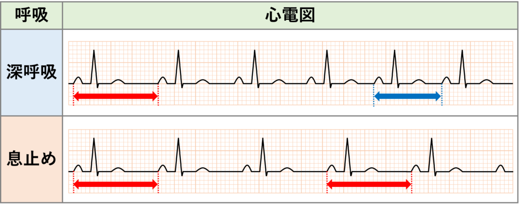 洞性不整脈(sinus arrhythmia)
呼吸性洞性不整脈(Respiratory Sinus Arrhythmia)