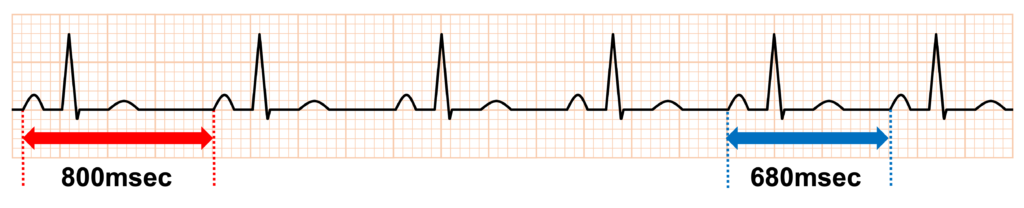 洞性不整脈(sinus arrhythmia)
呼吸性洞性不整脈(Respiratory Sinus Arrhythmia)