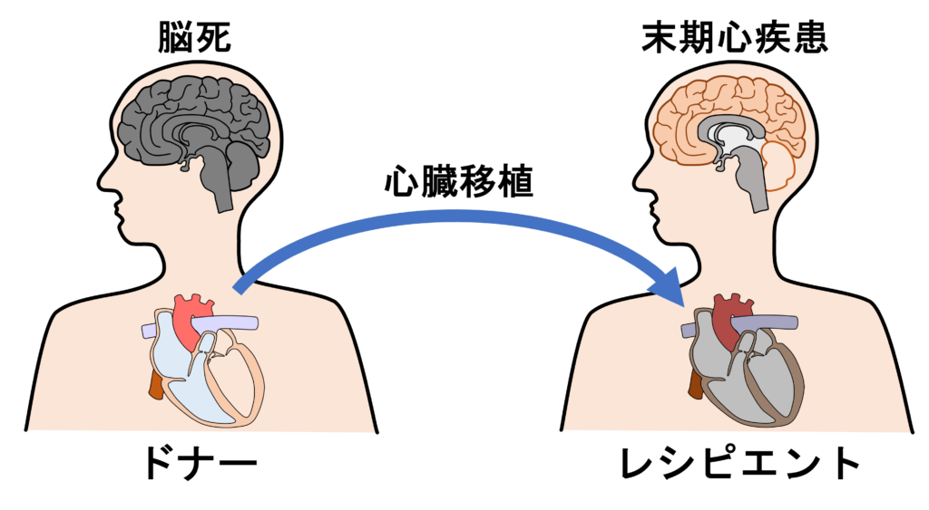 心臓移植(Heart transplantation)