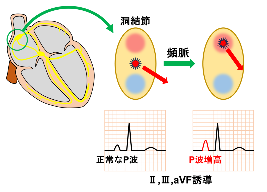 不適切洞頻脈(inappropriate sinus tachycardia)
洞性頻脈なのでP波の形態は洞調律時と同じになりますが、P波の振幅が頻脈時にやや高くなる傾向があり、これは頻脈時に洞結節の上方に興奮の起源が変位しているためと考えられます