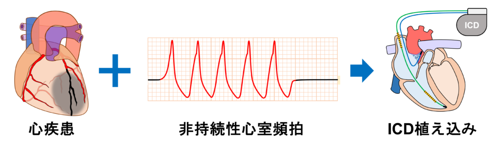 非持続性心室頻拍(Non-sustained ventricular tachycardia: NSVT)心臓に基礎疾患がある場合はNSVTは突然死のリスク因子になり、ICD植え込みが必要な場合があります。