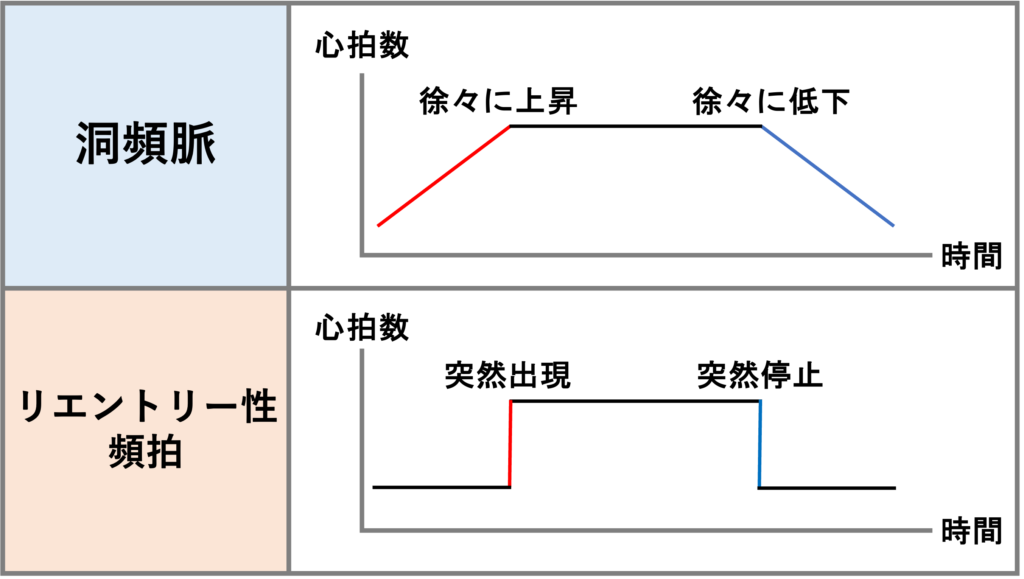洞頻脈(Sinus tachycardia)
洞頻脈の場合、急に出現して急に停止するリエントリー性の頻拍とは異なり、心拍数は徐々に上昇し、徐々に低下します