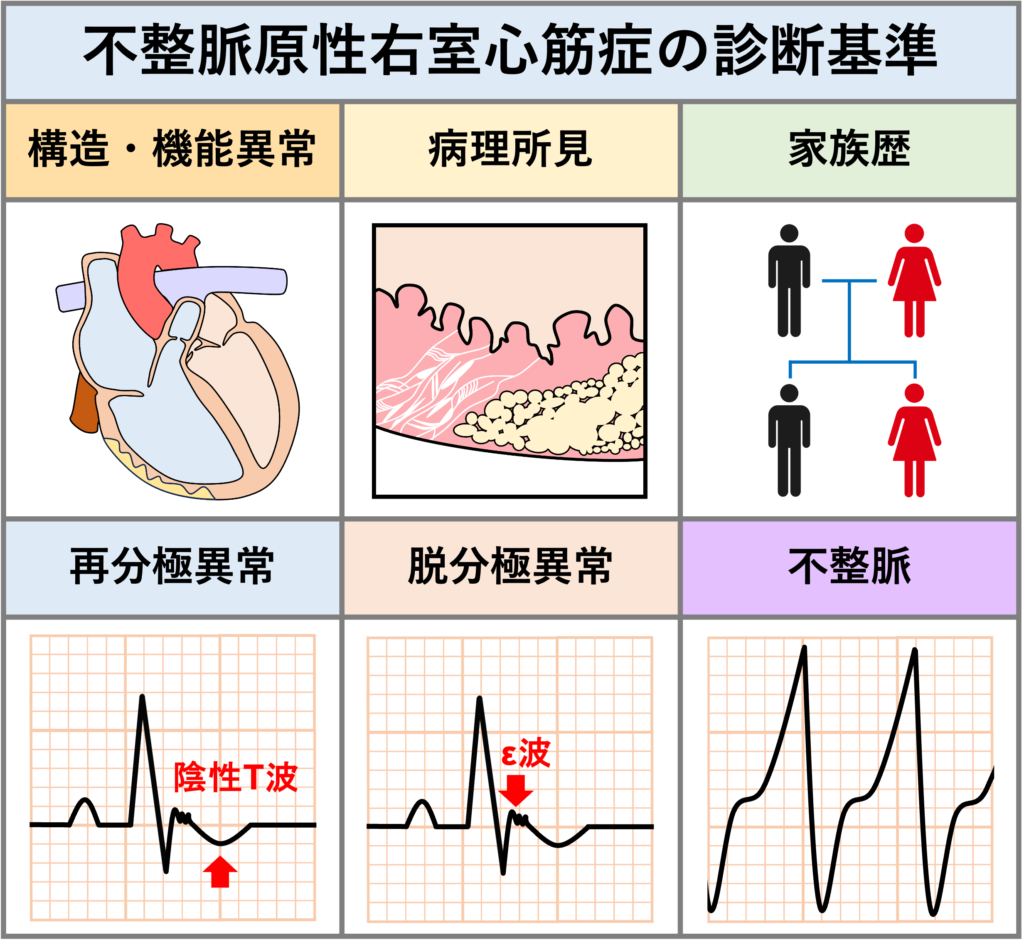 不整脈原性右室心筋症(arrhythmogenic right ventricular cardiomyopathy：ARVC)
診断基準の大元は、2010年にMarcusらより提唱されたModified Task Force Criteriaです。この診断基準は、心電図所見を含む6つの項目からなり、それぞれにMajor項目とMinor項目があります。日本の循環器学会からも診断基準が提唱されています