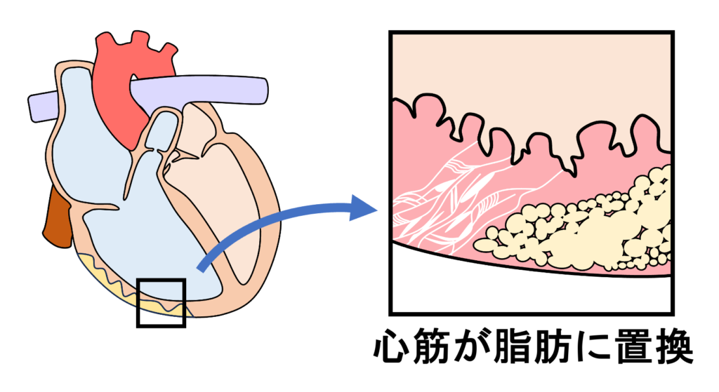 不整脈原性右室心筋症(arrhythmogenic right ventricular cardiomyopathy：ARVC)
不整脈原性右室心筋症は、主に遺伝的に決定される心筋疾患で、右室心筋の線維性脂肪置換(fibro-fatty change)を特徴としています