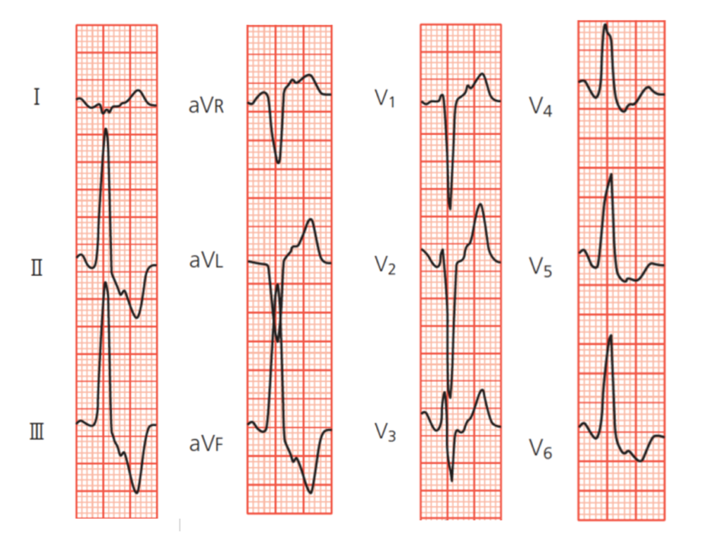 高位右室流出路中隔側が起源の心室期外収縮