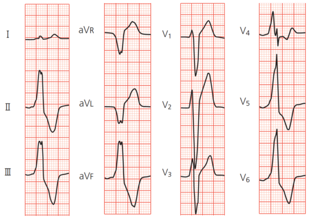 右室流出路起源心室期外収縮 RVOT PVC