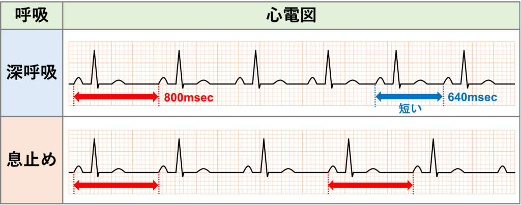 洞性不整脈(sinus arrhythmia)
呼吸性洞性不整脈(Respiratory Sinus Arrhythmia)
深呼吸すると変動が極端に大きくなり、息を止めると変動が小さくなりほぼ規則正しくなります。