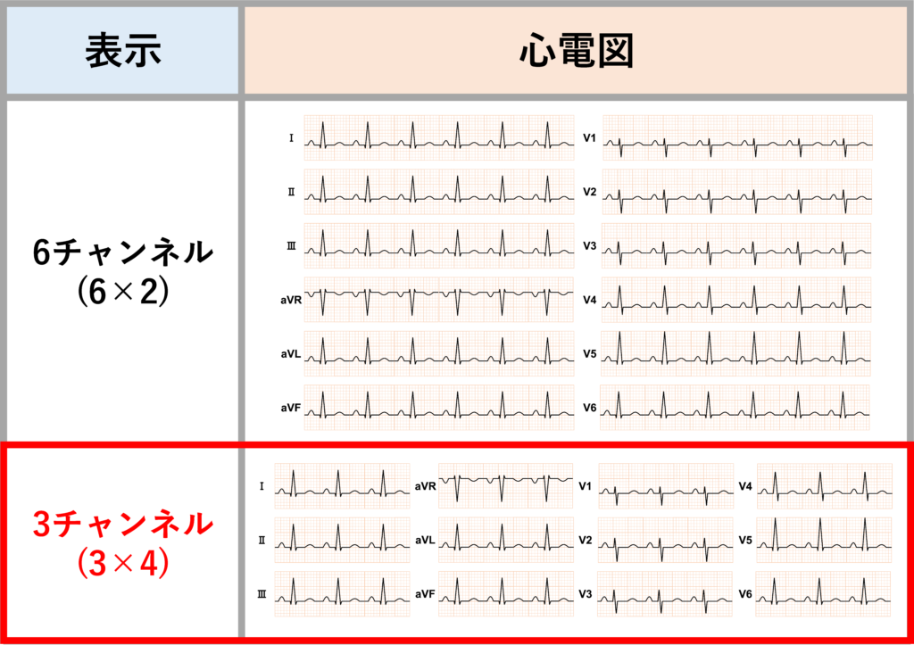South African flag signとは？
心電図記録の際、縦に6つの誘導を表示する場合(6チャンネル表示)と縦に3つの誘導を表示する場合(3チャンネル表示)がありますが、South African flag signでは縦に3つの誘導を表示する場合の変化になります