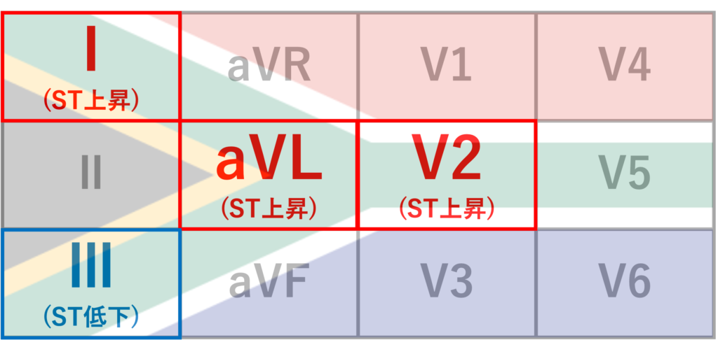 South African flag signとは？
心筋梗塞の梗塞部位によってI、aVL、V2誘導のST上昇とIII誘導のST低下のパターンが見られることがあり、これらI、aVL、V2、Ⅲ誘導の心電図記録上の位置関係が南アフリカの国旗の柄(緑色の線)に一致しています。