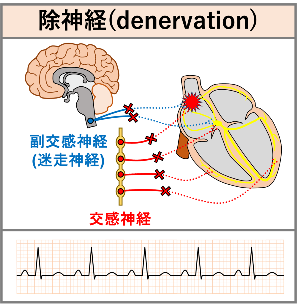 心臓移植(Heart transplantation)