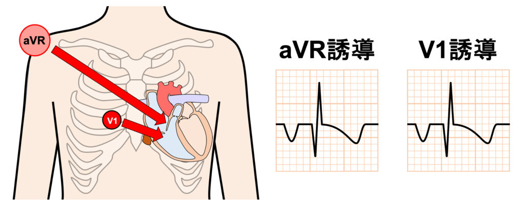 漏斗胸(pectus excavatum)
また、QRS波はQr波やqR波となり、aVR誘導の波形に類似することがあります。これは心臓の左方偏位が強く、V1誘導でも右上から心臓を見ているようなaVR誘導と似た位置関係になるからです。