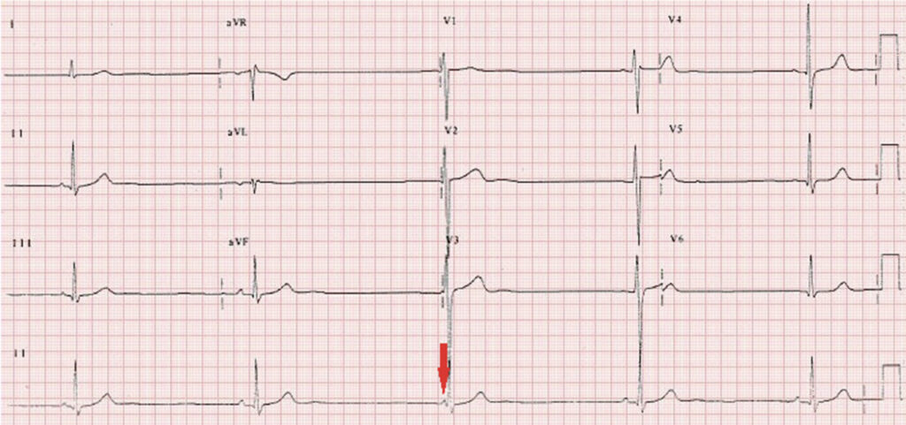 BRASH症候群とは？