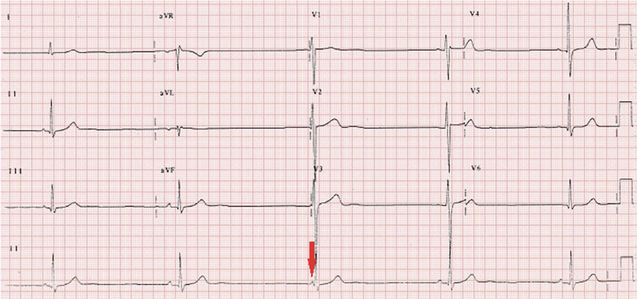 BRASH症候群とは？