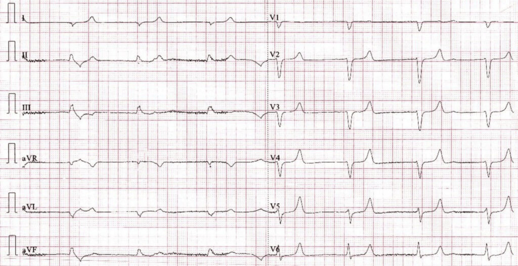 BRASH症候群とは？