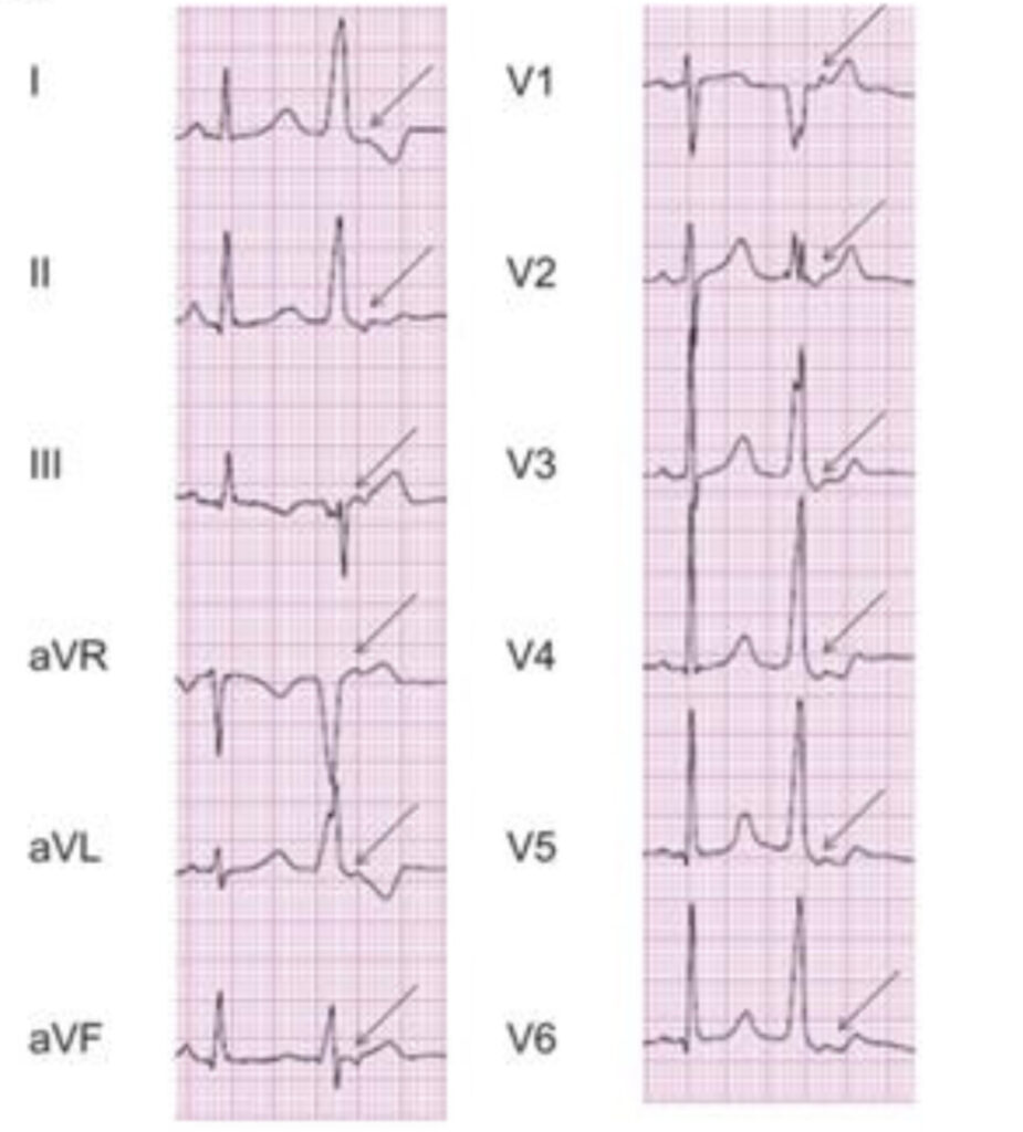 室房伝導(ventriculoatrial conduction)