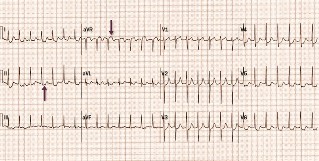 室房伝導(ventriculoatrial conduction)