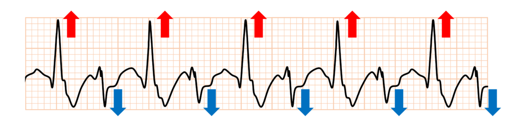 二方向性心室頻拍(bidirectional VT)