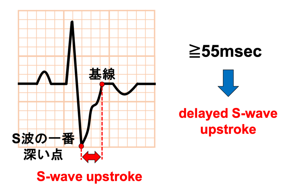 不整脈原性右室心筋症(arrhythmogenic right ventricular cardiomyopathy:ARVC)
elayed S-wave upstrokeとはS波の立ち上がりが遅れてなだらかになることを言います。S-wave upstrokeはS波の一番深い点から基線に戻るまでの時間で定義されます。S-wave upstrokeはV1-3誘導で判定し、55msec以上で有意な遅れとします。心電図所見の中で最も感度が高いとする報告もあります。診断基準の脱分極異常のMinor項目に含まれています。
