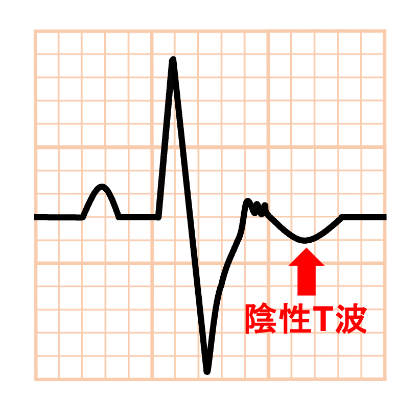 不整脈原性右室心筋症(arrhythmogenic right ventricular cardiomyopathy:ARVC)