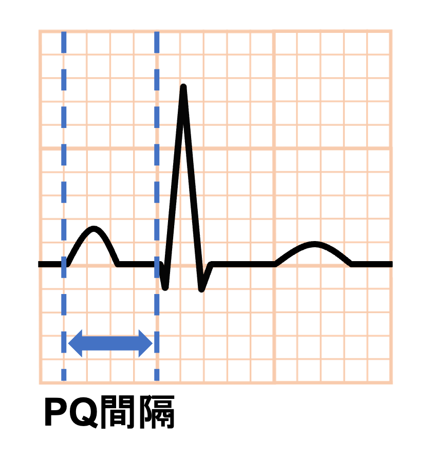 PQ間隔(PQ interval)
P波の始まりからQ波の始まりまでをPQ間隔と言います。Q波が存在しないこともあるので、その場合はR波の始まりまでを基準にしてPR間隔(PR interval)とも呼ばれます。