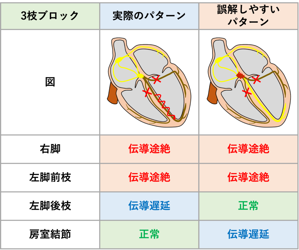 ３枝ブロック(trifascicular block)