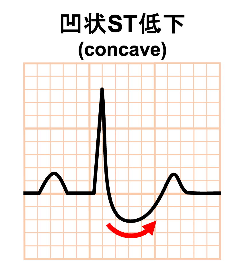 家族性ST低下症候群の心電図
凹状(concave)のST低下