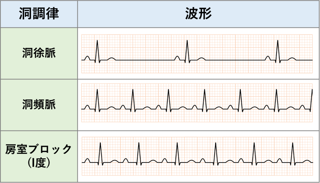 洞調律(sinus rhythm)
洞結節由来の調律であれば洞調律となるため、広い意味では洞徐脈、洞頻脈、洞不整脈、房室ブロックも洞調律に含まれます。注意点としては正常洞調律と洞調律はイコールではありません。「正常」洞調律では心室への伝導含めて心電図所見が正常になります。