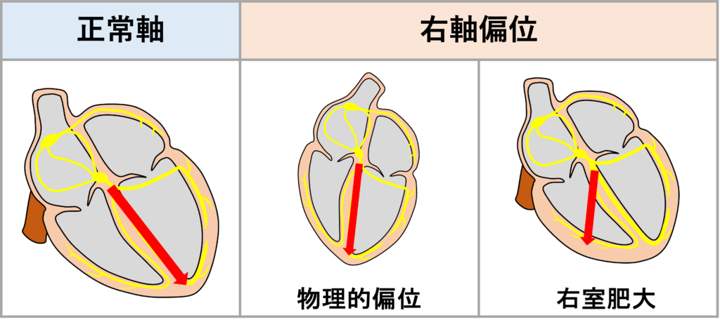 右軸偏位(right axis deviation)