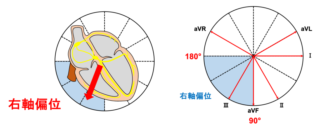 右軸偏位(right axis deviation)