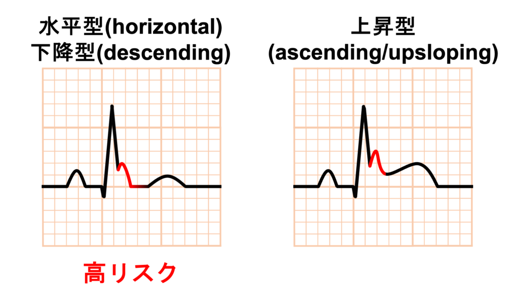 早期再分極症候群(early repolarization syndrome)