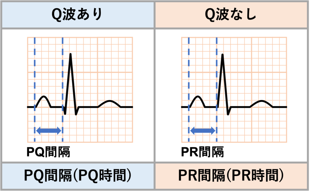 PQ間隔(PQ interval)
P波の始まりからQ波の始まりまでをPQ間隔と言います。Q波が存在しないこともあるので、その場合はR波の始まりまでを基準にしてPR間隔(PR interval)とも呼ばれます。