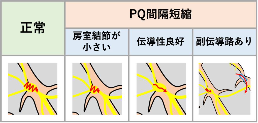 PQ間隔(PQ interval)