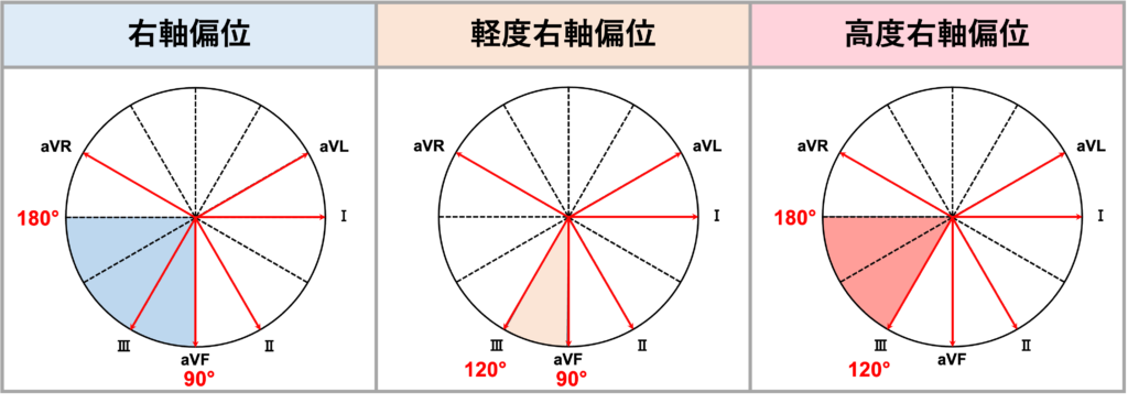 右軸偏位(right axis deviation)
定義上はQRS波の電気軸が90°〜180°の時が右軸偏位になります。また、QRS波の電気軸が90°〜120°の時を軽度右軸偏位、120°〜180°の時を高度右軸偏位と分類する場合もあります